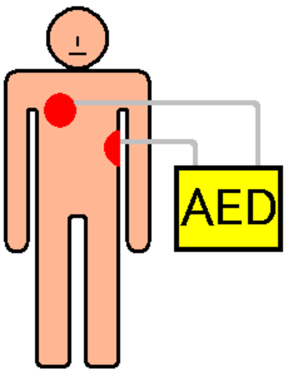 AED Pad Positioning