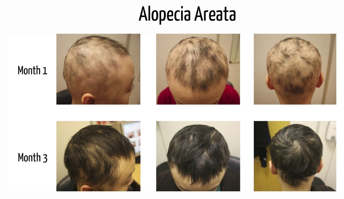 Alopecia Areato