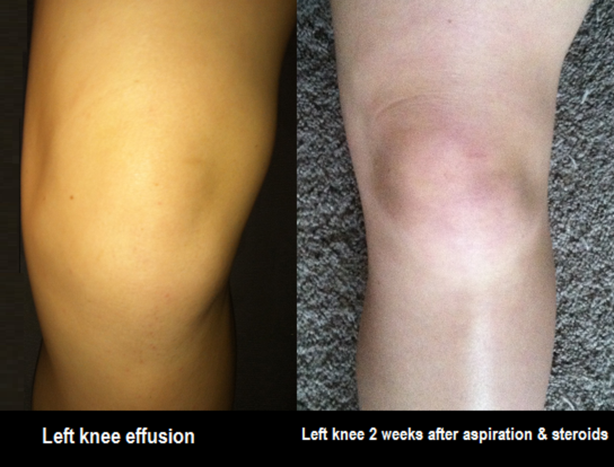 Initial left knee effusion before & after aspiration & steroid injections
