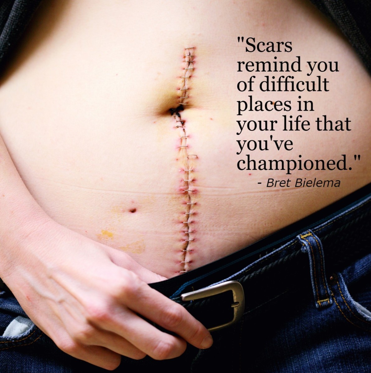 "Scars remind you of difficult places in your life that you've championed." - Bret Bielema, American football coach
