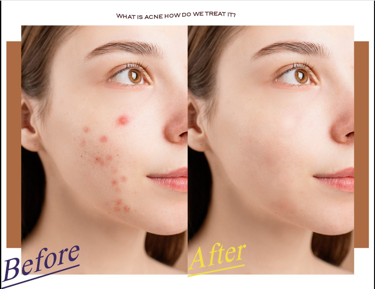 what-is-acne-and-how-do-we-treat-it
