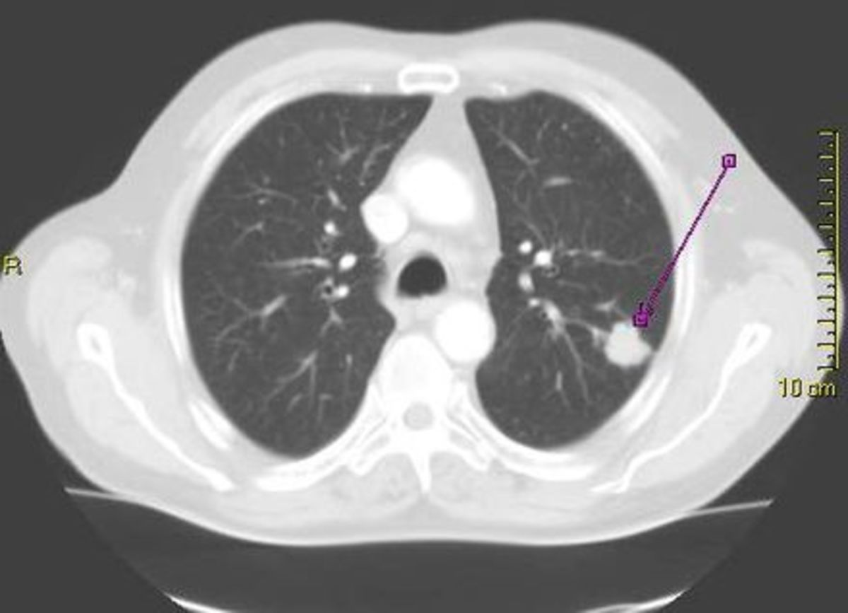 CT scan showing a cancerous tumor in the left lung Wikipedia.com 