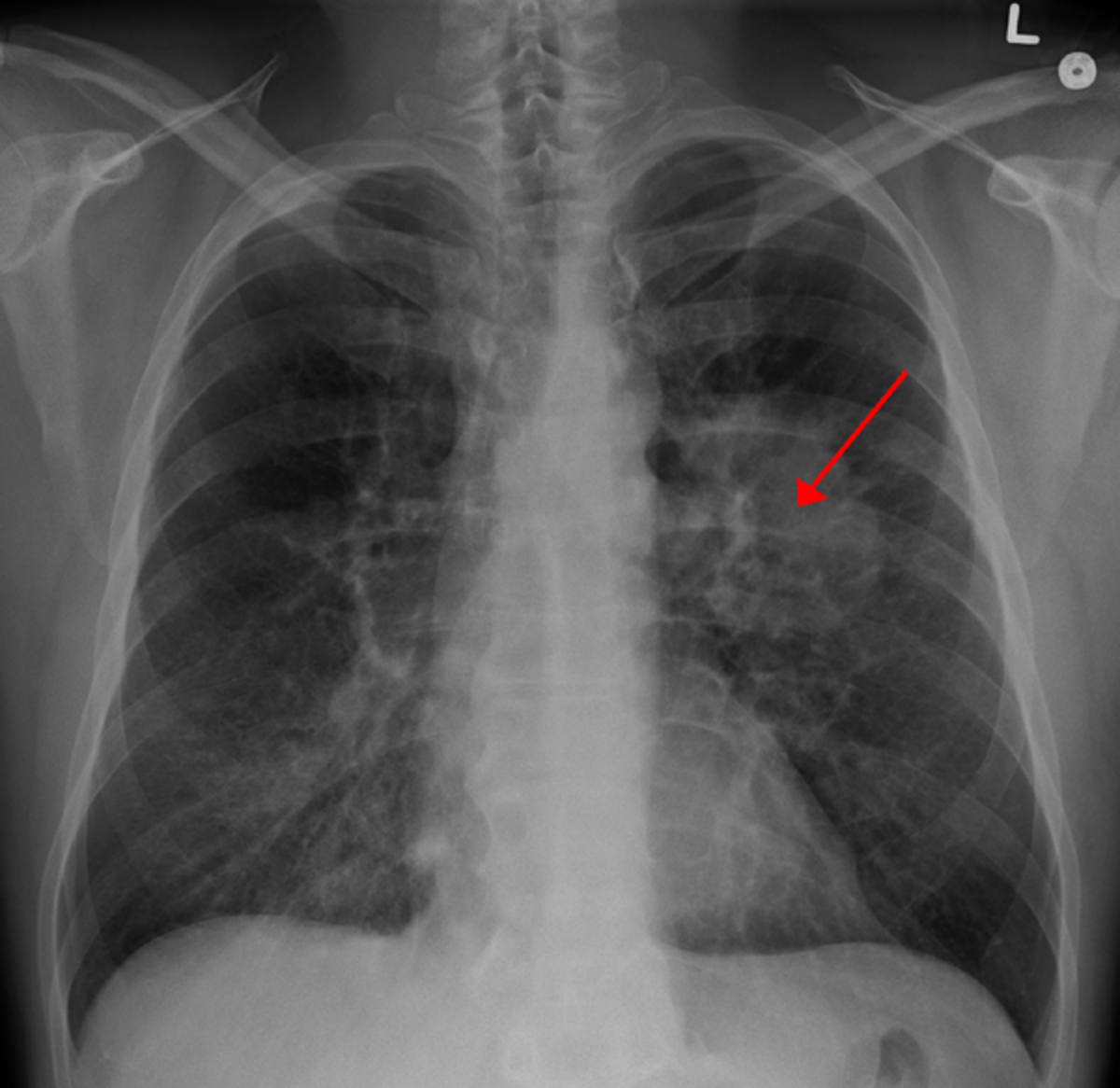 A chest X-ray showing a tumor in the lung (marked by arrow) Wikipedia.com