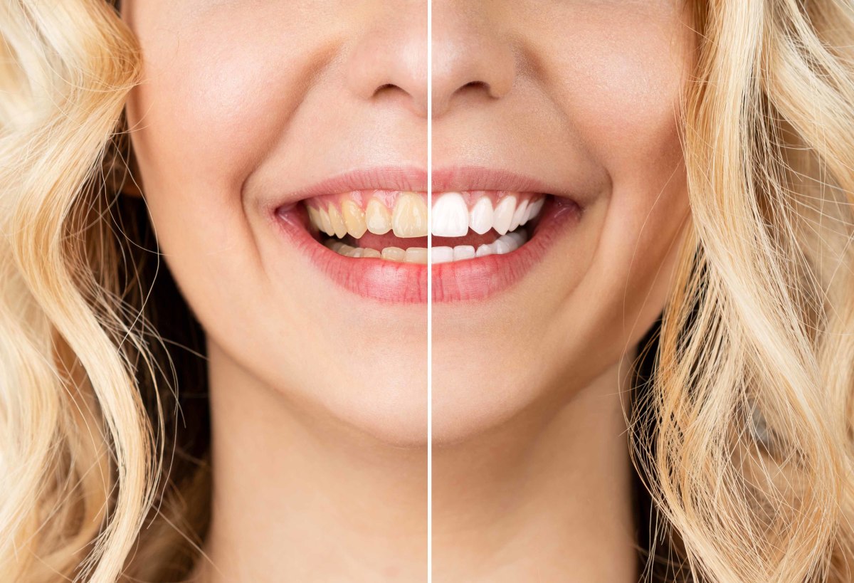 Teeth Whitening Steps in Photoshop