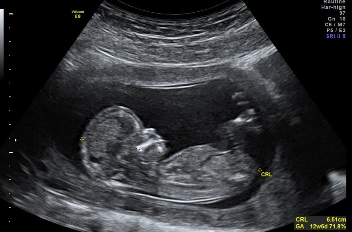 Could sexual orientation be determined in the womb?