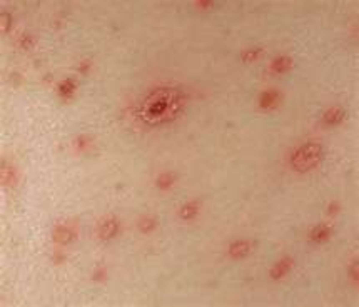 Chigger Symptoms and Treatment