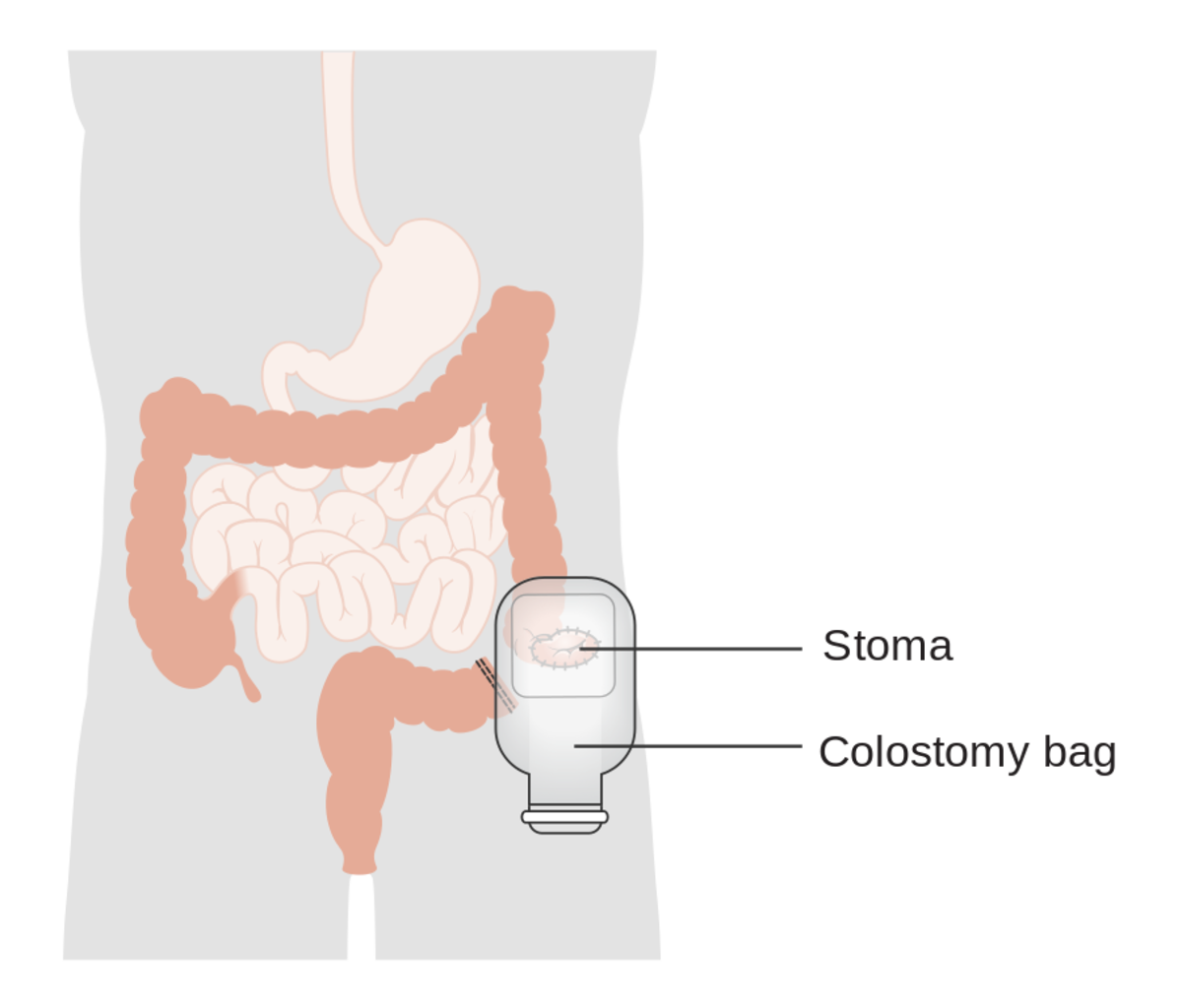 Here are some examples of what having a colostomy bag was like for me. 