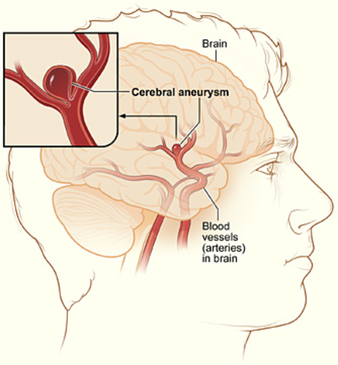 An aneurysm is the swelling of the wall of a blood vessel.