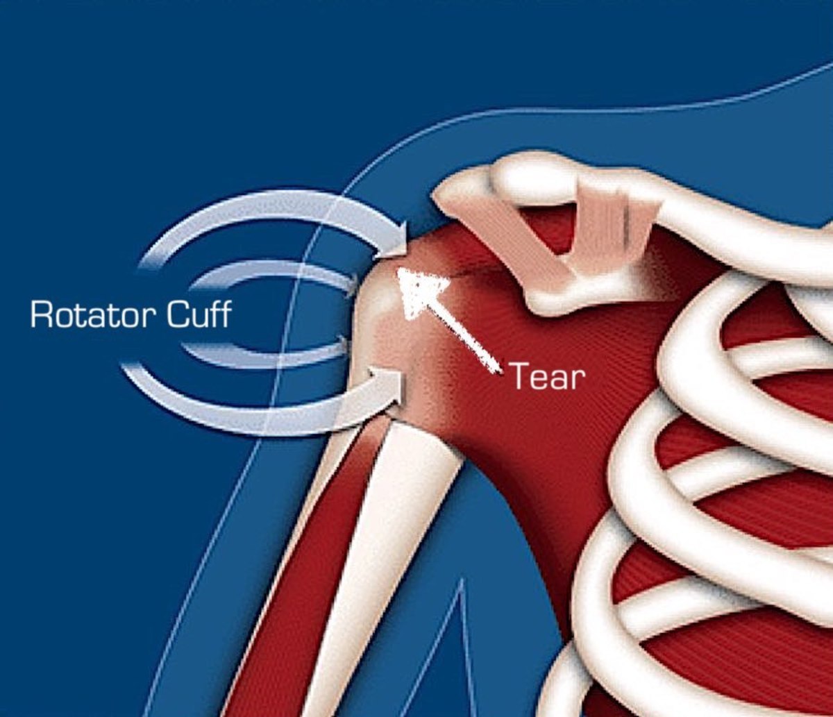 How I Avoided Shoulder Surgery For A Torn Rotator Cuff - Patient's Lounge