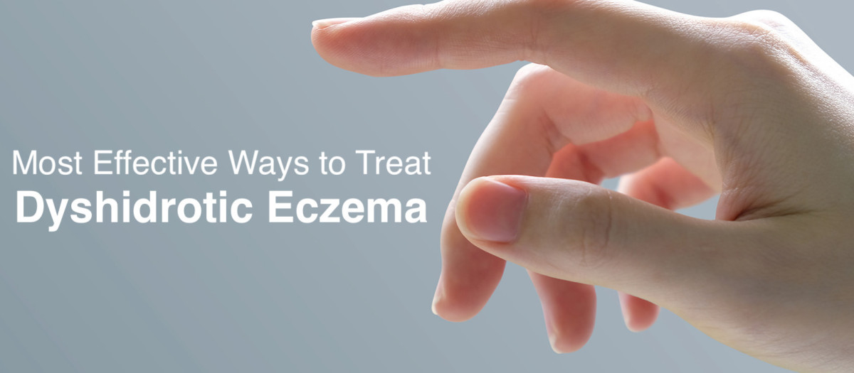 The most effective ways to treat dyshidrotic eczema