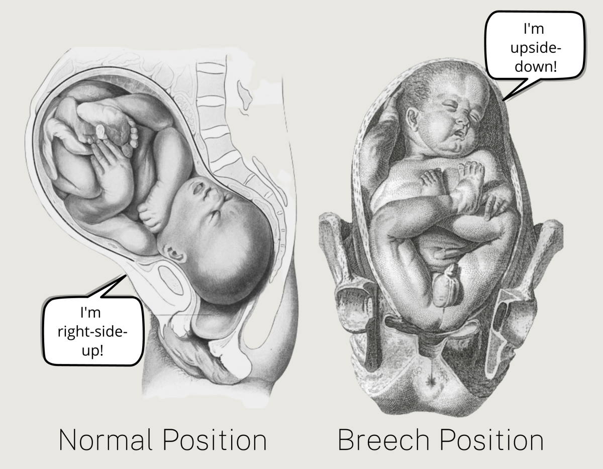 Image of what a "normal" birthing position looks like vs. a breech position.