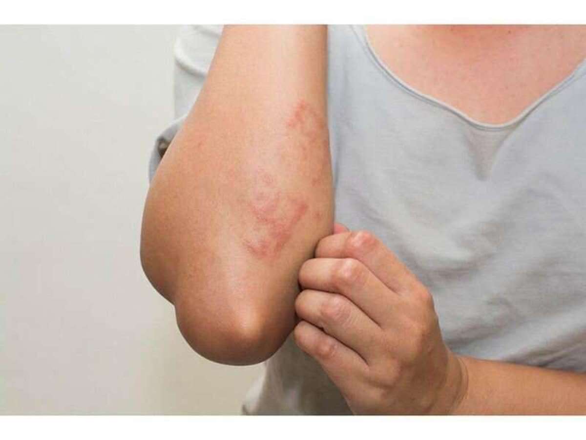 Symptoms of Hives as an Allergic Reaction