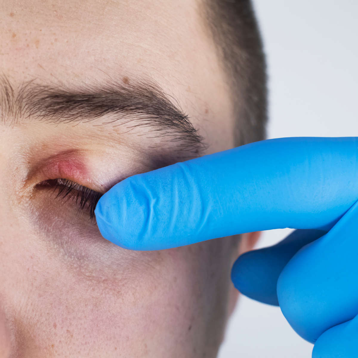 Here are some tips to help relieve your eyelid discomfort. 