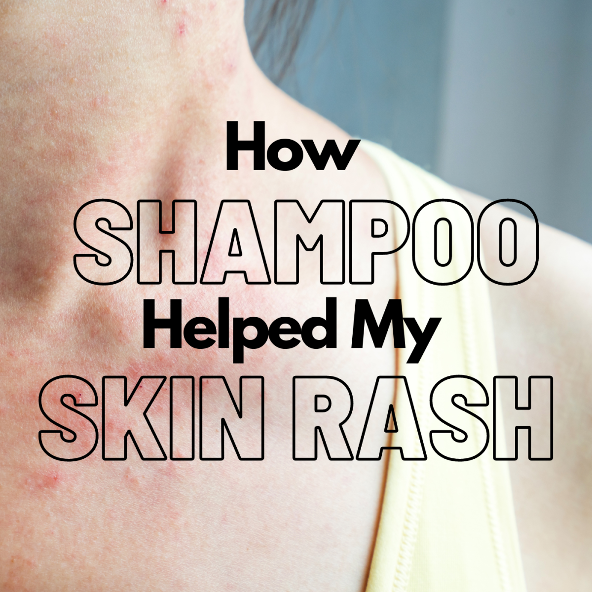 How Selsun Blue helped my skin rash