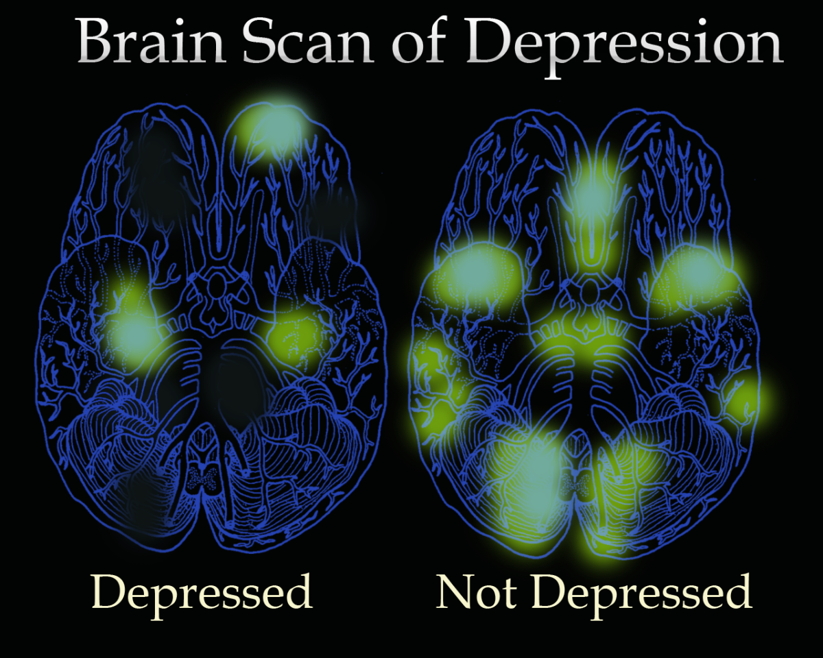 A simulation of a Brain Scan on Depression