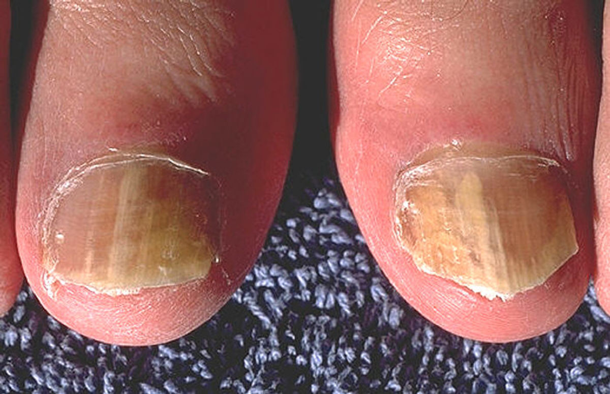The General Manifestations, Diagnosis And Treatments Of Systemic Fungal Infections