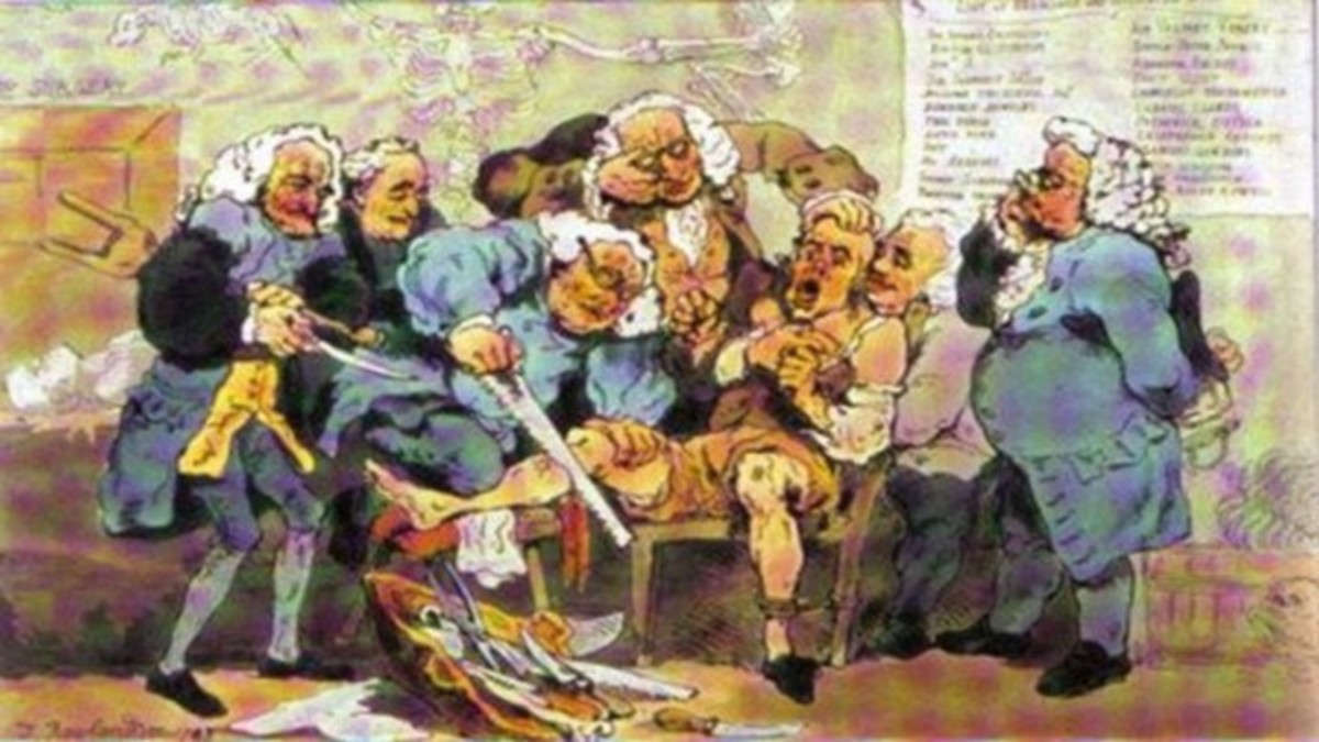 A painting depicting the amputation of a patience leg without anesthesia