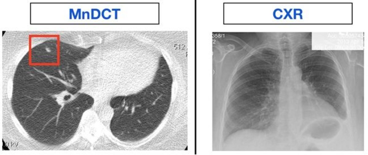 The low-dose lung cancer detection CT is much more accurate than a simple chest x-ray in detecting small malignancies in the lungs.