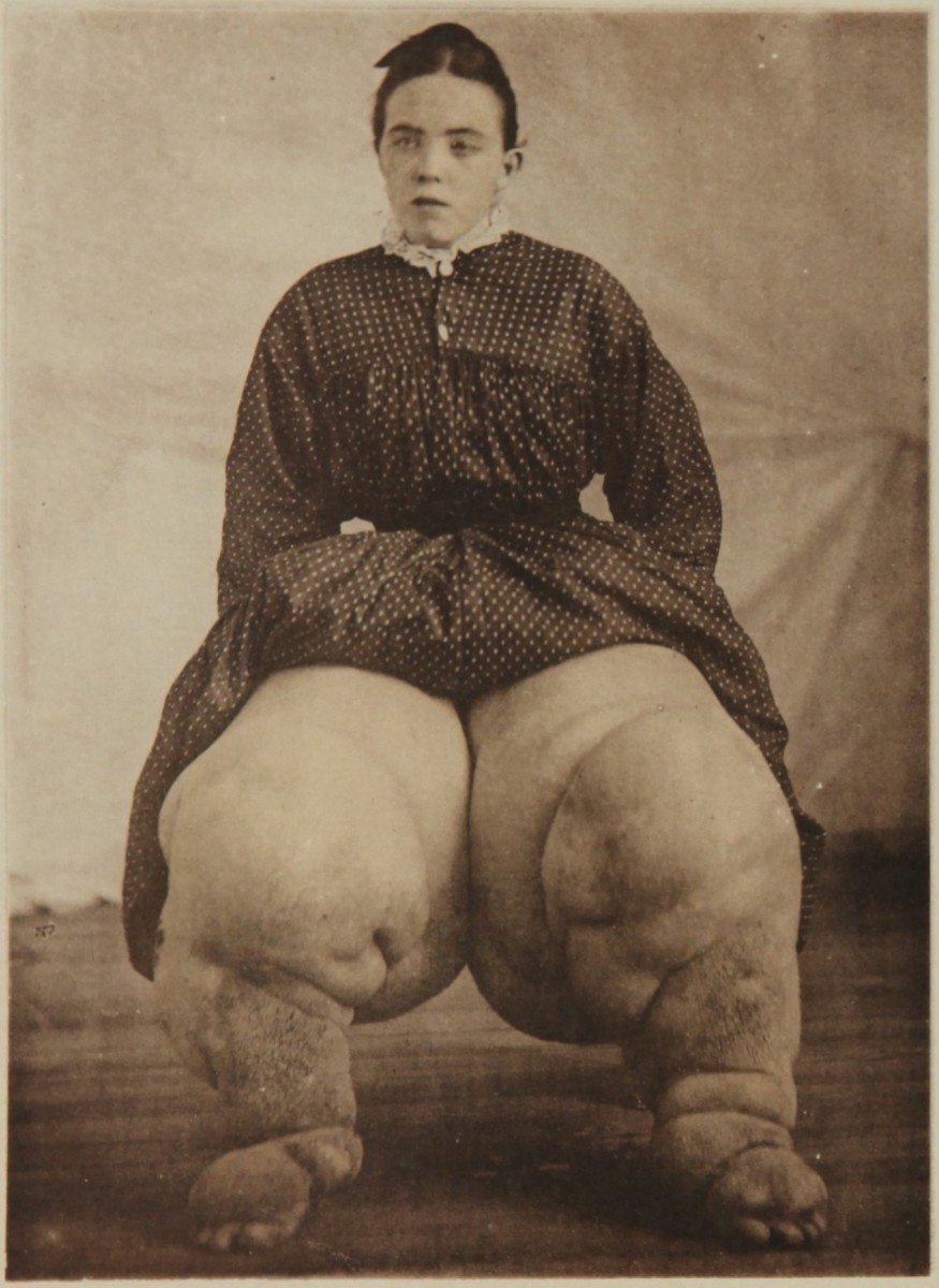 Elephantiasis patient. Name A. C., age 19. Her lower extremities were enlarged from childhood after "post-scarlatinal edema". 