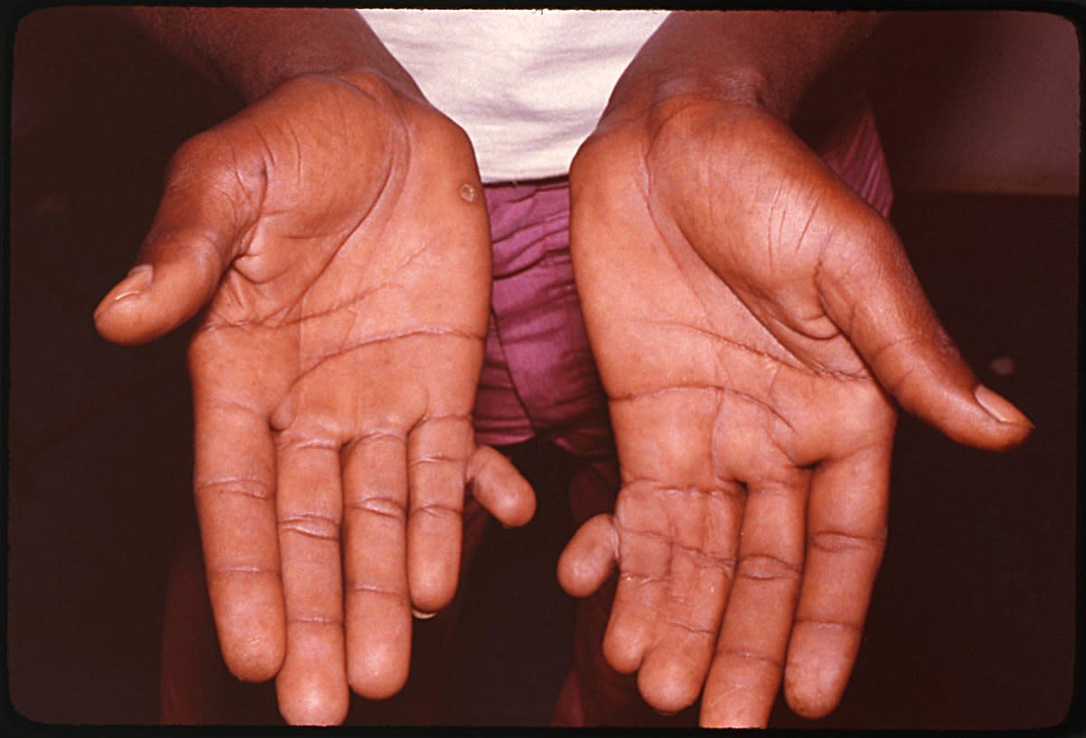Man in Brazil with extra fingers 