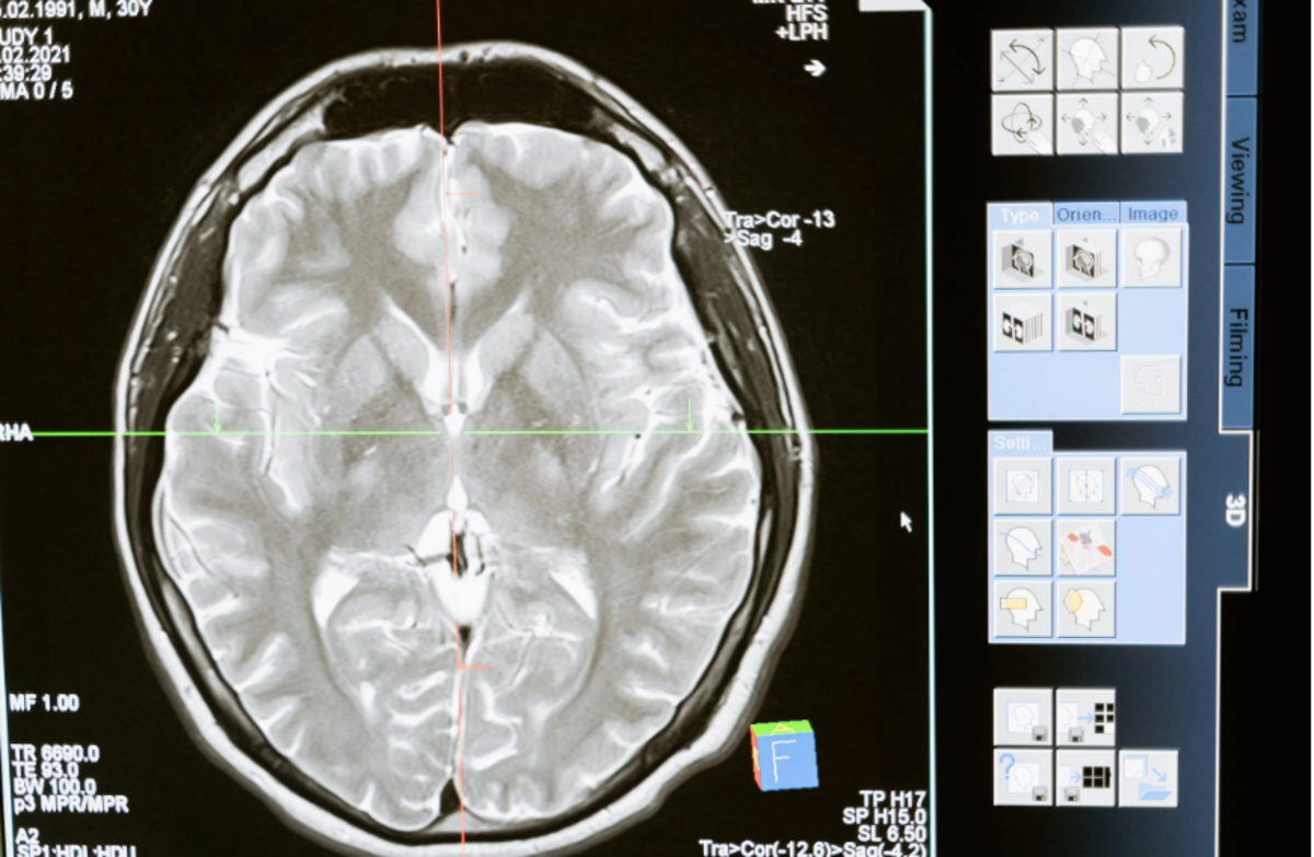 A CT scan can help detect problems associated with cerebrospinal pressure