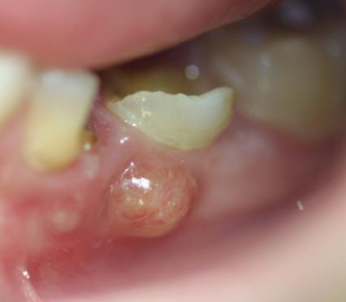 A  broken down tooth with abscess and draining pus