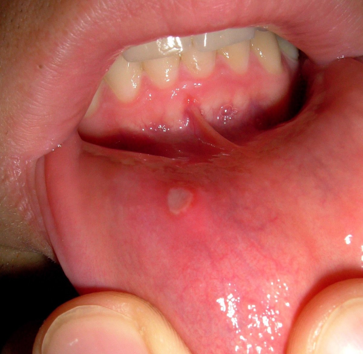 How to Prevent Recurring Canker Sores and Speed up Healing of Those Existing