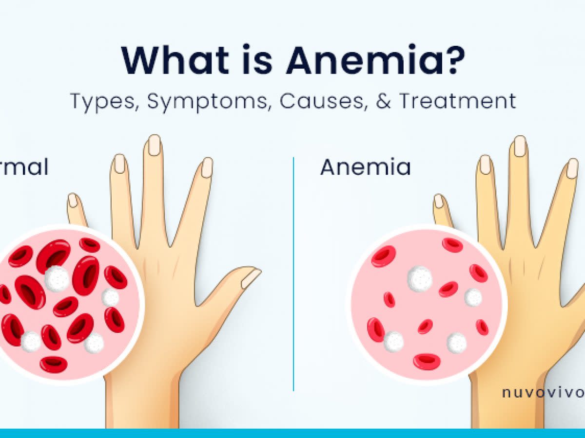 Anemia Causes And How You Can Avoid It - HubPages