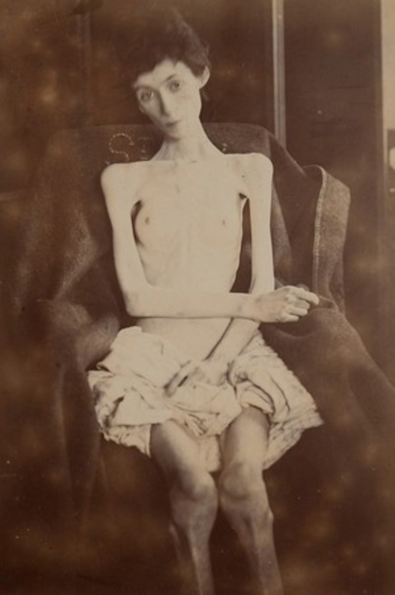 Anorexia Signs and Treatment for the Condition.