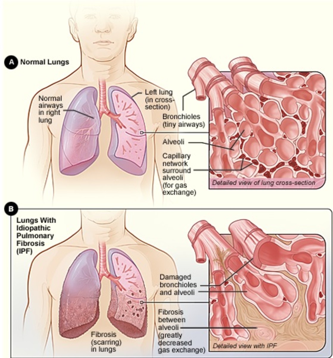 5 Alternate Ways to Treat Pulmonary Fibrosis
