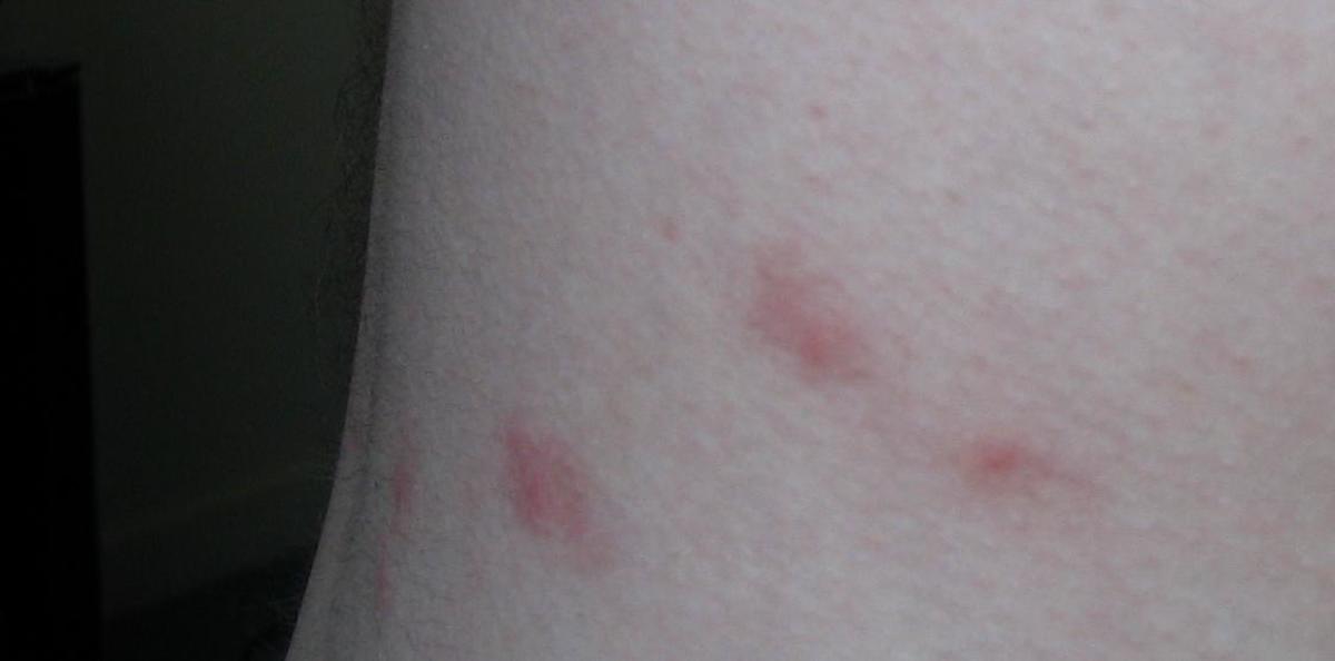 Flea Bites on Humans: Symptoms, Treatment, and More - Dengarden