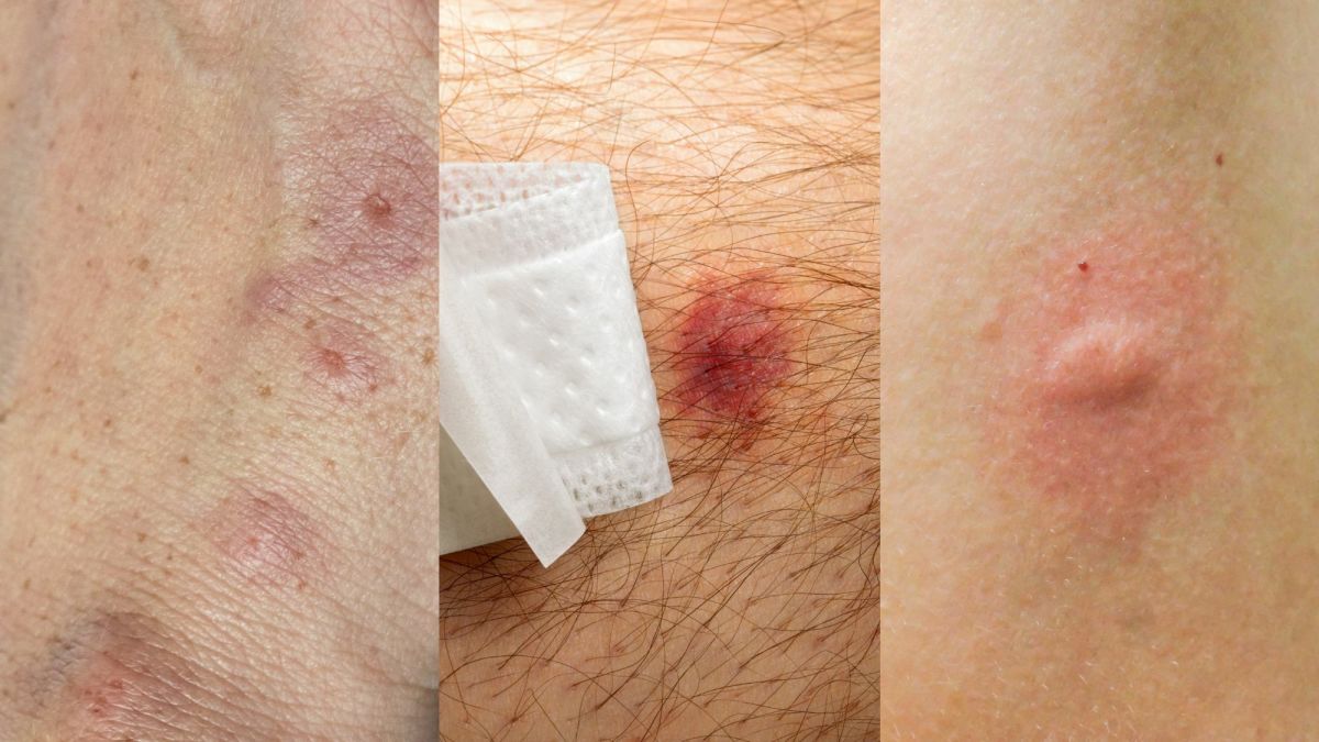 Bed Bug vs. Mosquito and Other Insect Bites