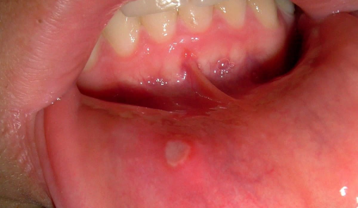 How to Prevent, and Speed up Healing of Recurring Canker Sores