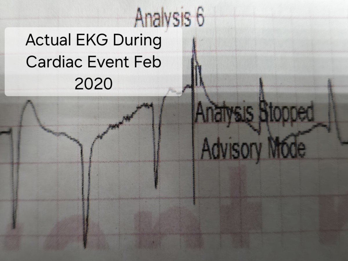 I Complained for a Year About Chest Pain and Still Had a Cardiac Arrest at 41.