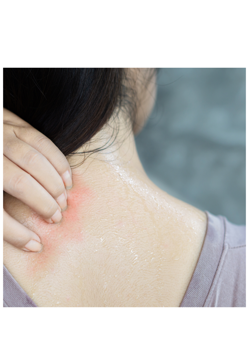 Simple Home Remedies for Jock Itch or Sweat Rash