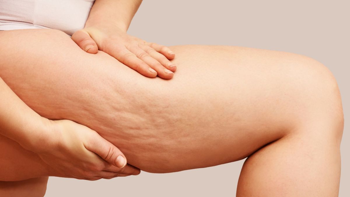 Proven Strategies for Losing Cellulite
