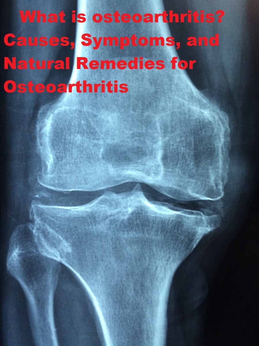 Osteoarthritis: Symptoms, Causes and Natural Remedies for Osteoarthritis