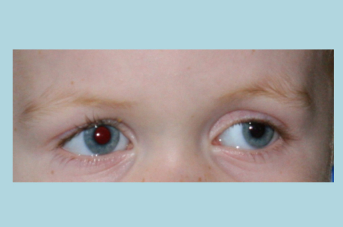 An example of strabismus (this is my son's left eye wandering outward). This is NOT the same as amblyopia. In fact, my son's amblyopic eye is the one that is looking straight ahead! Amblyopia is invisible to the outside observer.