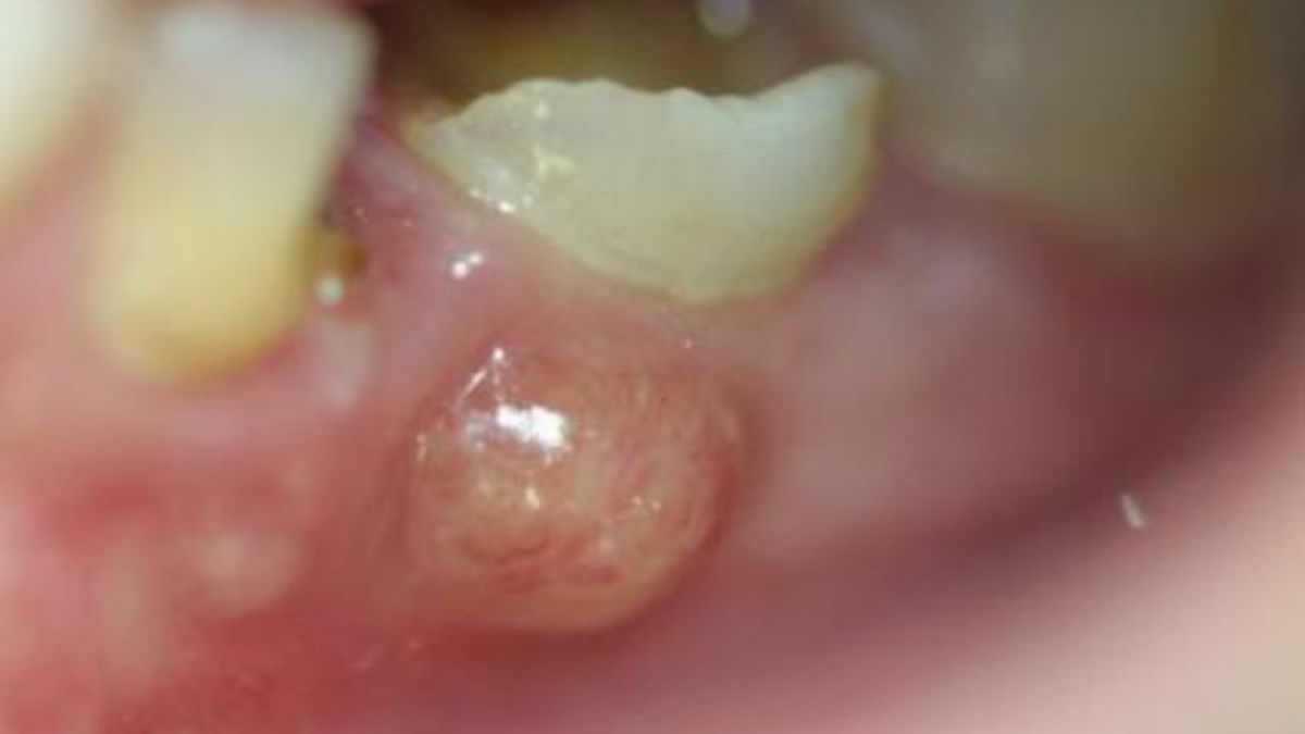 How to Drain a Gum Abscess at Home? Do This Instead