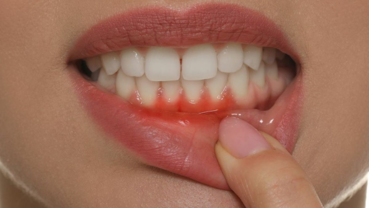 Gums Peeling? How to Fix Them Before It’s Too Late