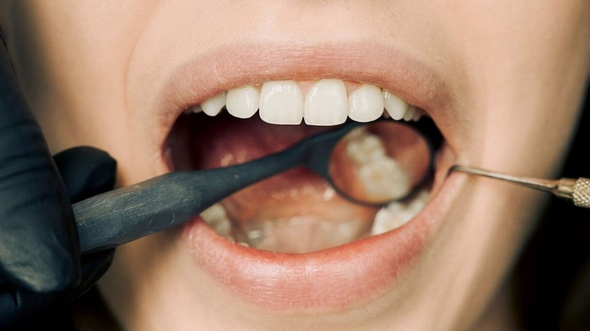 12 Steps to Reverse Periodontal Disease Naturally - YouMeMindBody