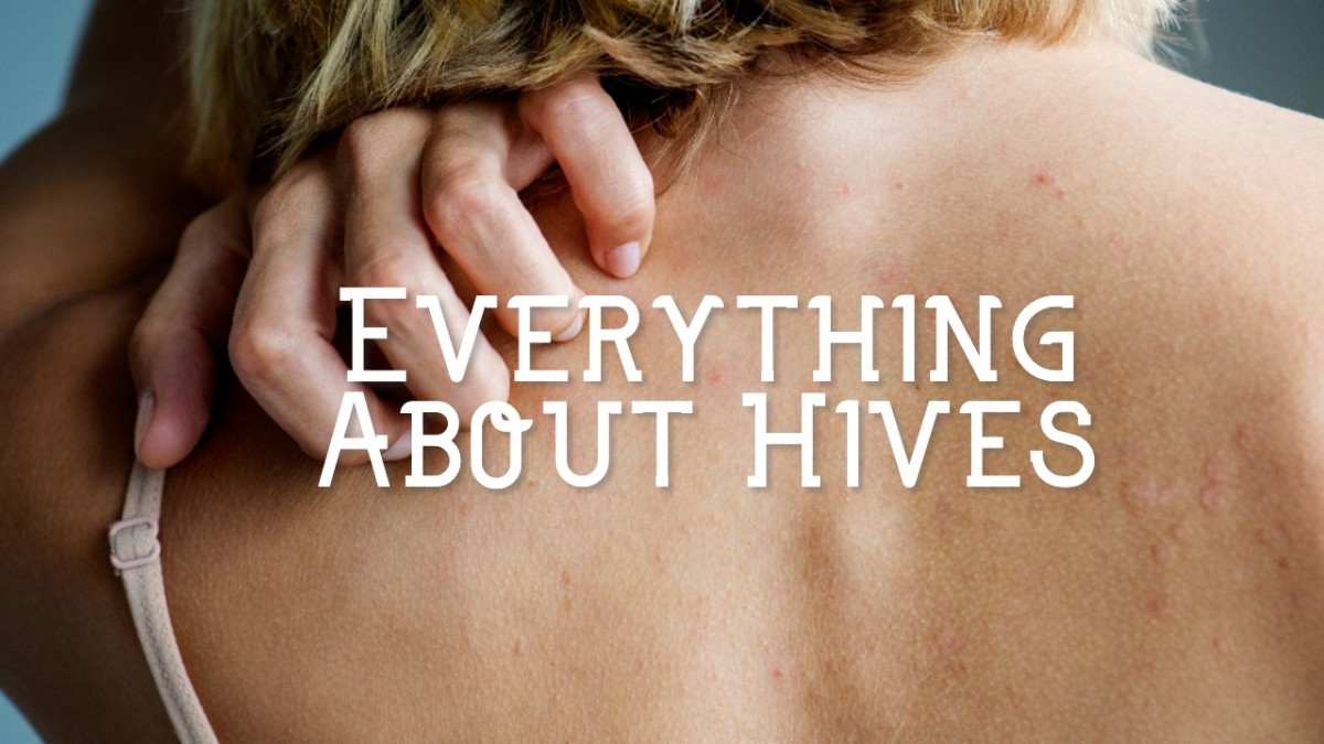 What Causes Hives and How to Treat Them