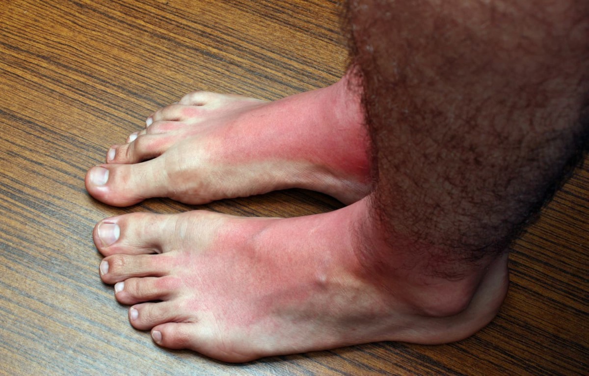 10 Tips to Soothe, Heal, and Prevent Sunburnt Feet