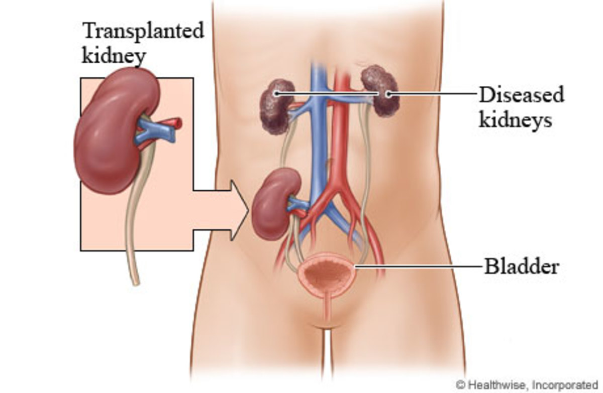 Kidney Transplantation Procedure and information about donor and recipient
