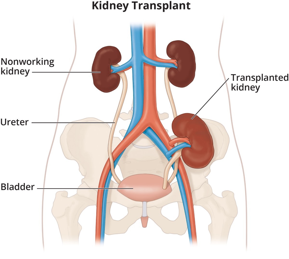 Kidney Transplantation Procedure And Information About Donor And 