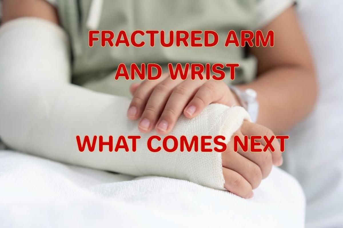 Fractured Arm and Wrist My Recovery Experience YouMeMindBody
