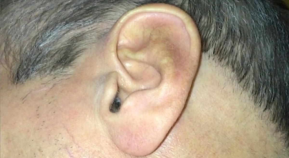 The Correct Way to Remove Impacted Earwax That Worked for Me