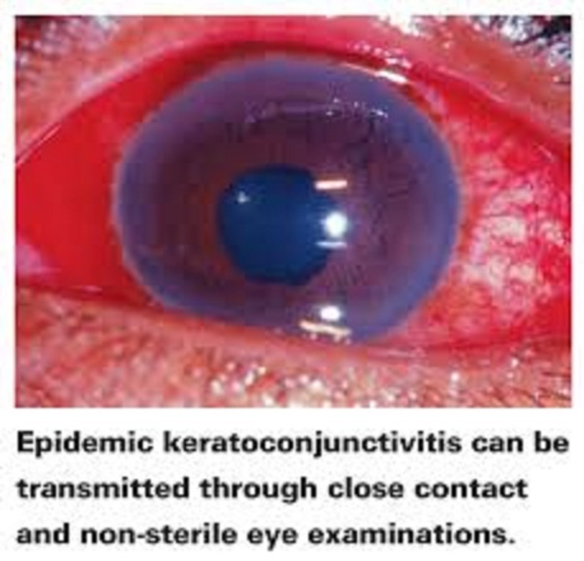 Adeno Viral Kerato Conjunctivitis
