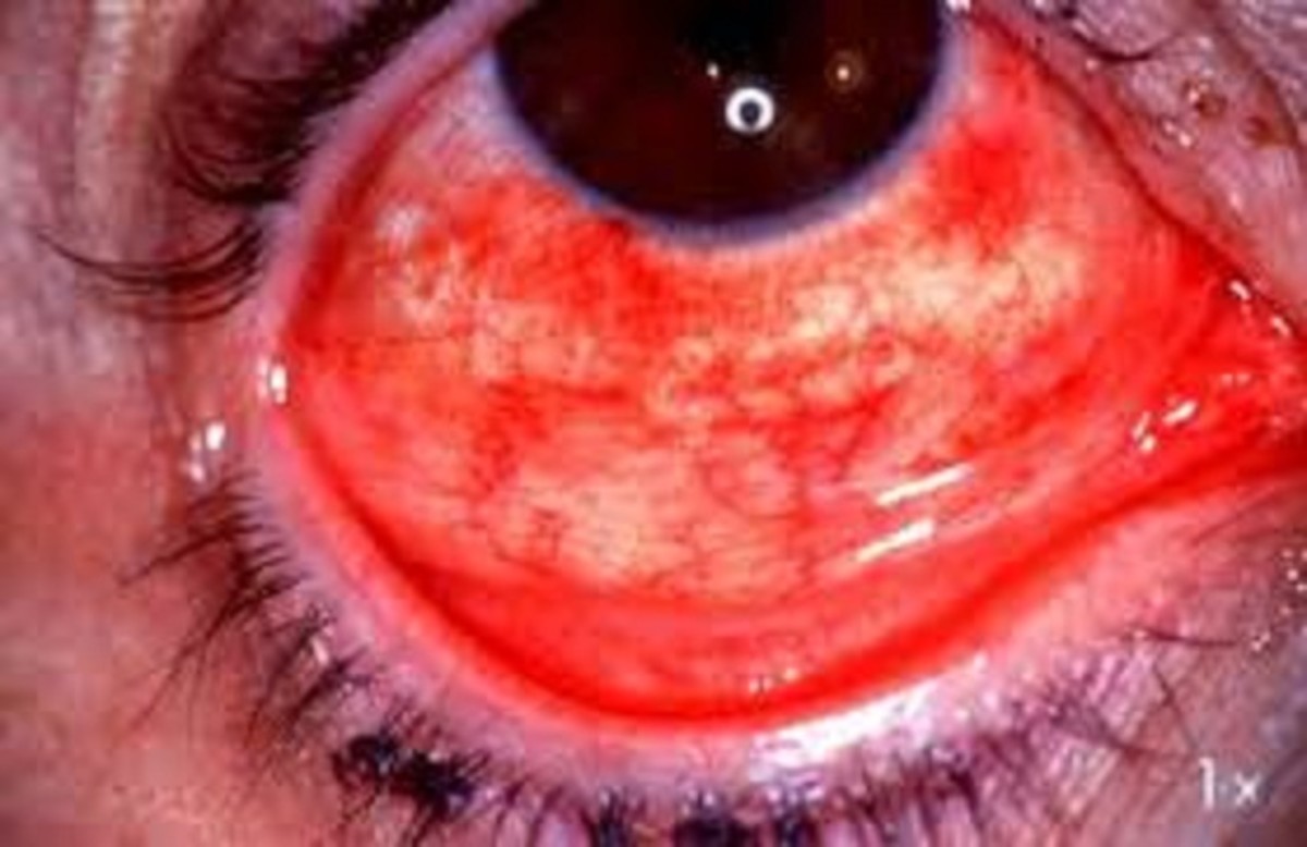 Adeno Viral Kerato Conjunctivitis