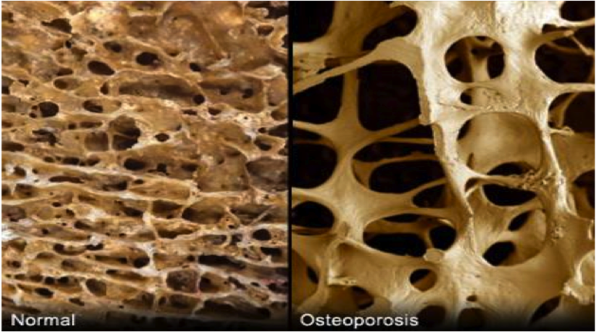 Bone Health: How to Keep Healthy Bones - HubPages